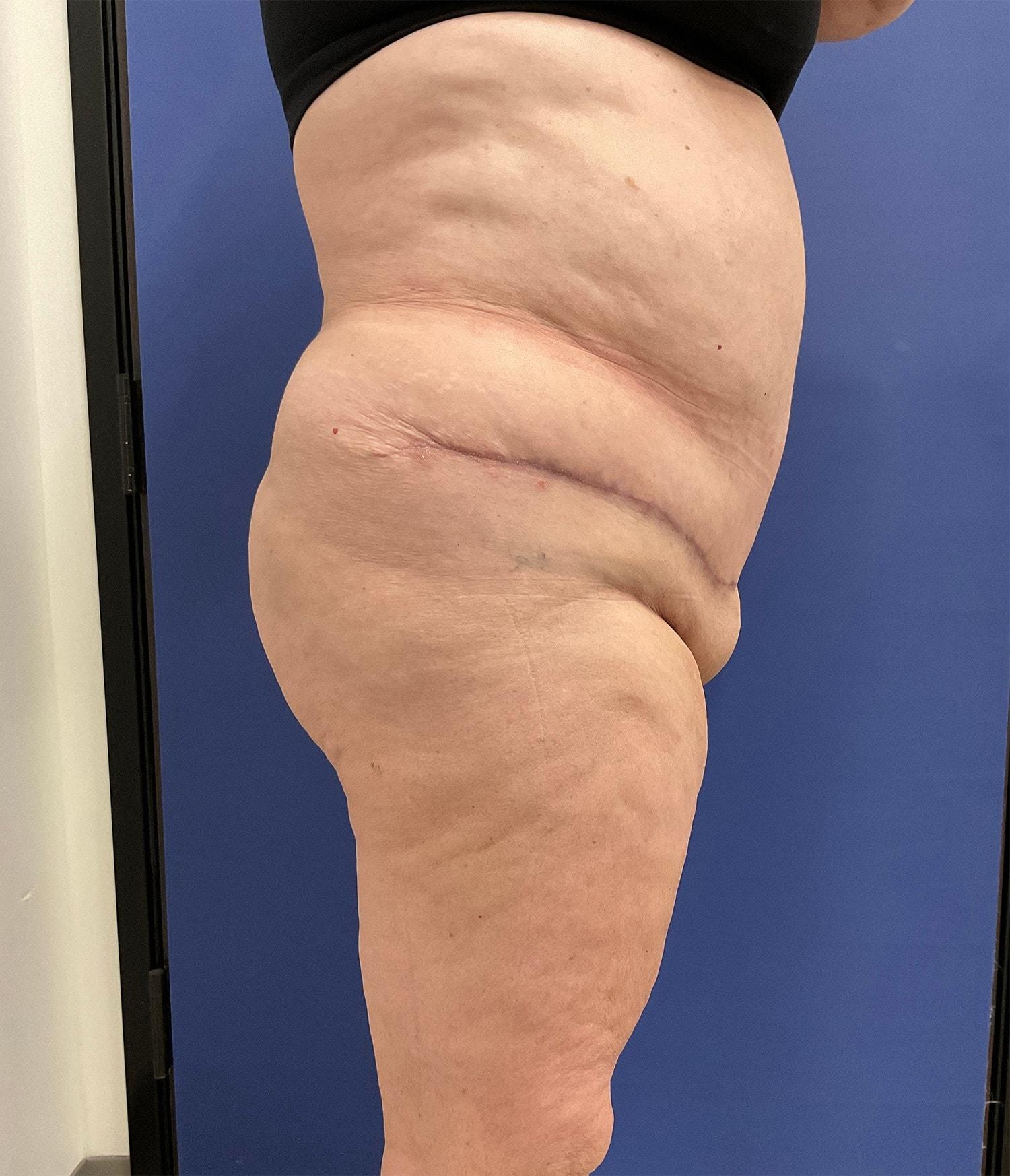 Robert Kearney, MD, FACS tummy tuck after — San Diego, CA