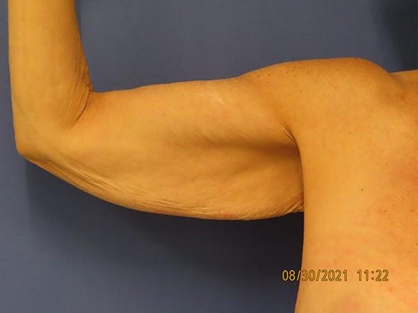 Arm Lift before at Robert Kearney, MD, FACS in San Diego, CA