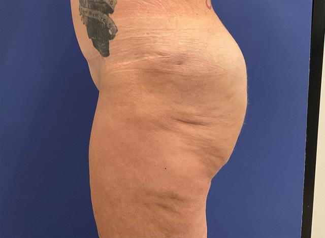 Brazilian Butt Lift after at Robert Kearney, MD, FACS in San Diego, CA