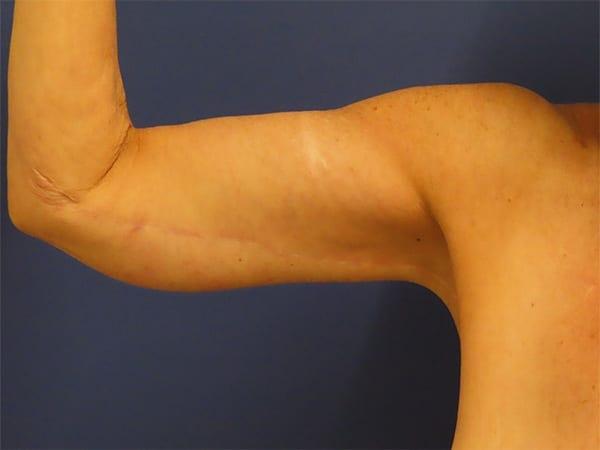 Arm Lift after at Robert Kearney, MD, FACS in San Diego, CA
