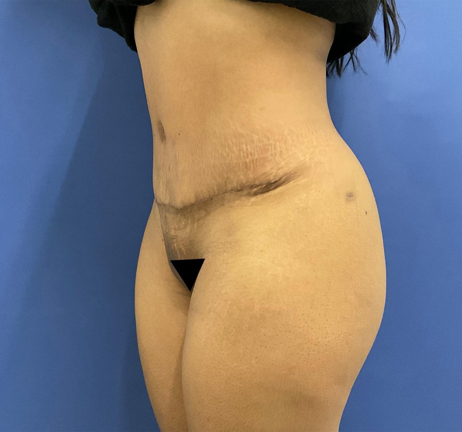 Robert Kearney, MD, FACS tummy tuck after — San Diego, CA