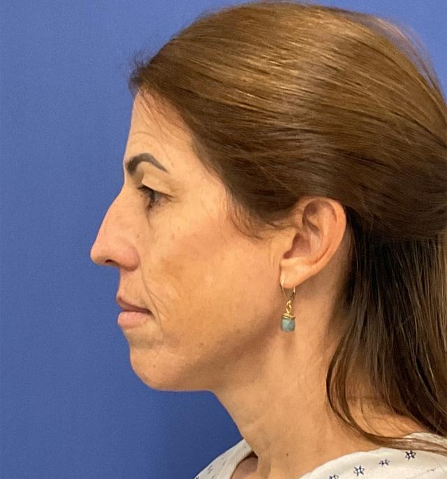 Chemical Peel before at Robert Kearney, MD, FACS in San Diego, CA