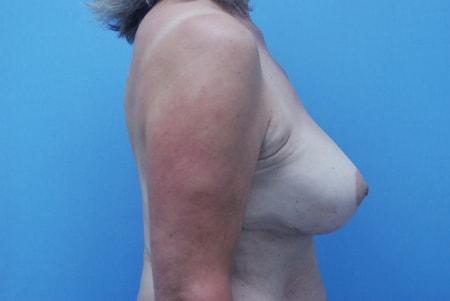 Breast Lift after at Robert Kearney, MD, FACS in San Diego, CA
