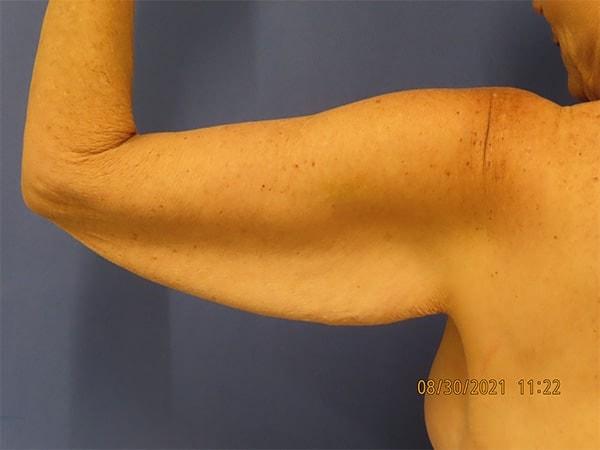 Arm Lift before at Robert Kearney, MD, FACS in San Diego, CA
