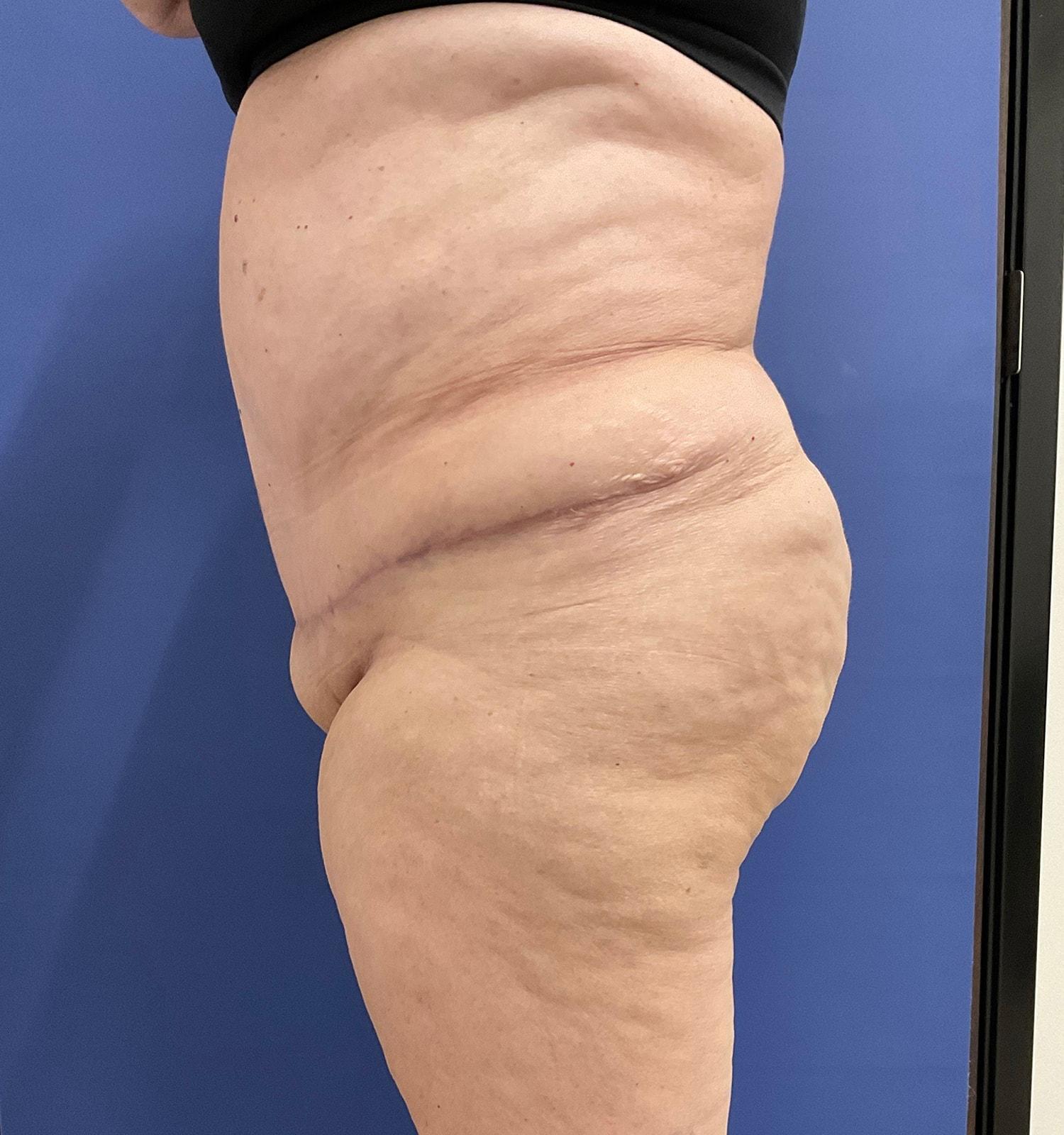 Robert Kearney, MD, FACS tummy tuck after — San Diego, CA