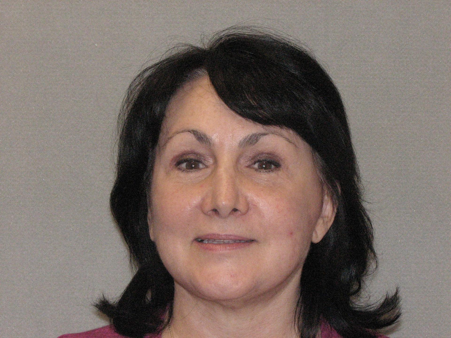 The Zimmerman Center for Plastic Surgery (Terry Zimmerman, MD) facelift after — Folsom, CA