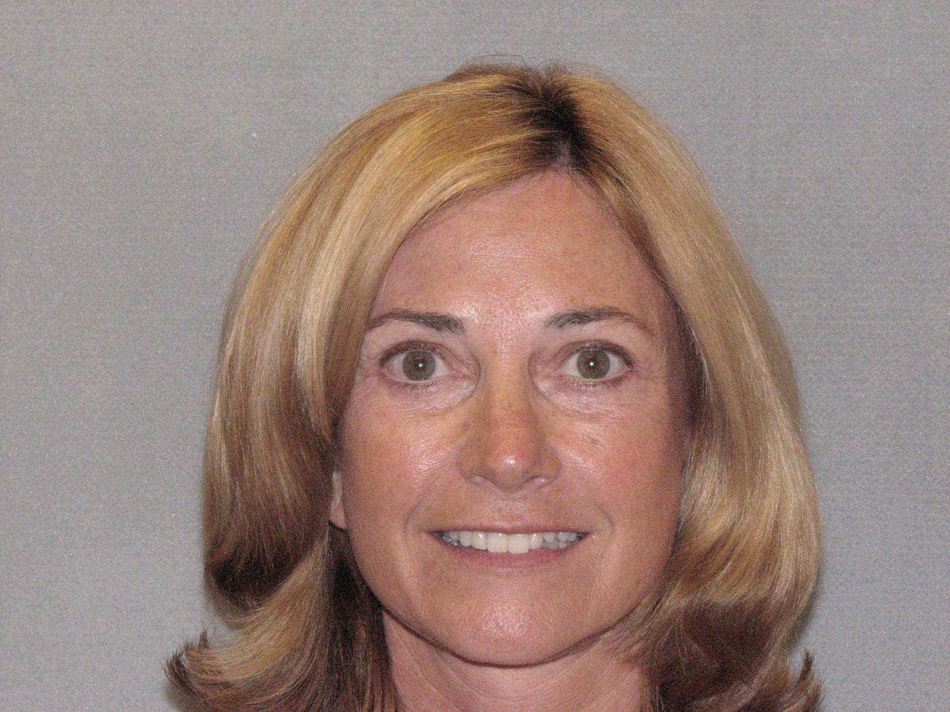 The Zimmerman Center for Plastic Surgery (Terry Zimmerman, MD) facelift after — Folsom, CA
