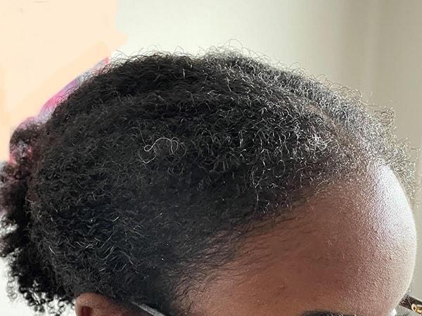 JEV Plastic Surgery & Medical Aesthetics hair restoration after — Owings Mills, MD