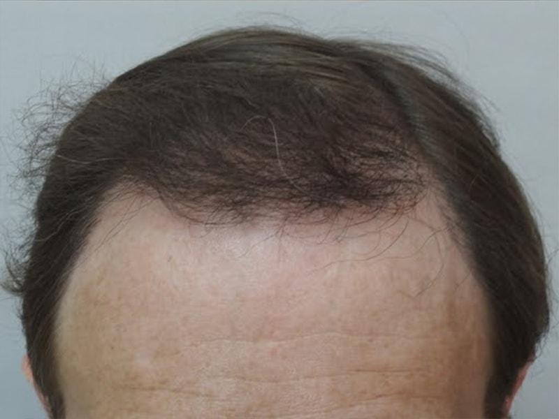 JEV Plastic Surgery & Medical Aesthetics hair restoration after — Owings Mills, MD