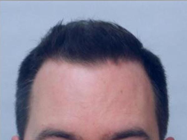 JEV Plastic Surgery & Medical Aesthetics hair restoration after — Owings Mills, MD