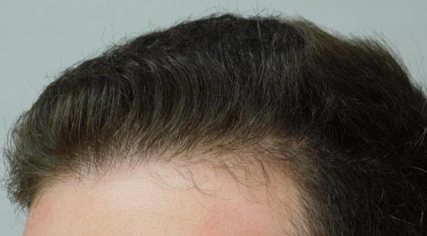 JEV Plastic Surgery & Medical Aesthetics hair restoration after — Owings Mills, MD