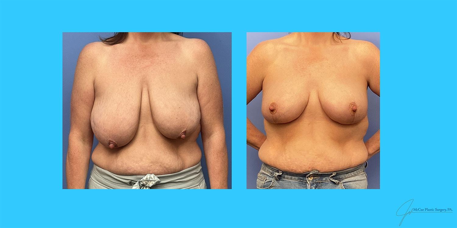 McCue Plastic Surgery breast reduction result — Plymouth, MN
