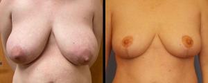 McCue Plastic Surgery breast reduction result — Minneapolis, MN