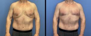 Arm Lift result at McCue Plastic Surgery in Minneapolis, MN