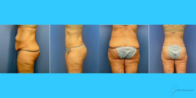 Mini Tummy Tuck result at McCue Plastic Surgery in Plymouth, MN