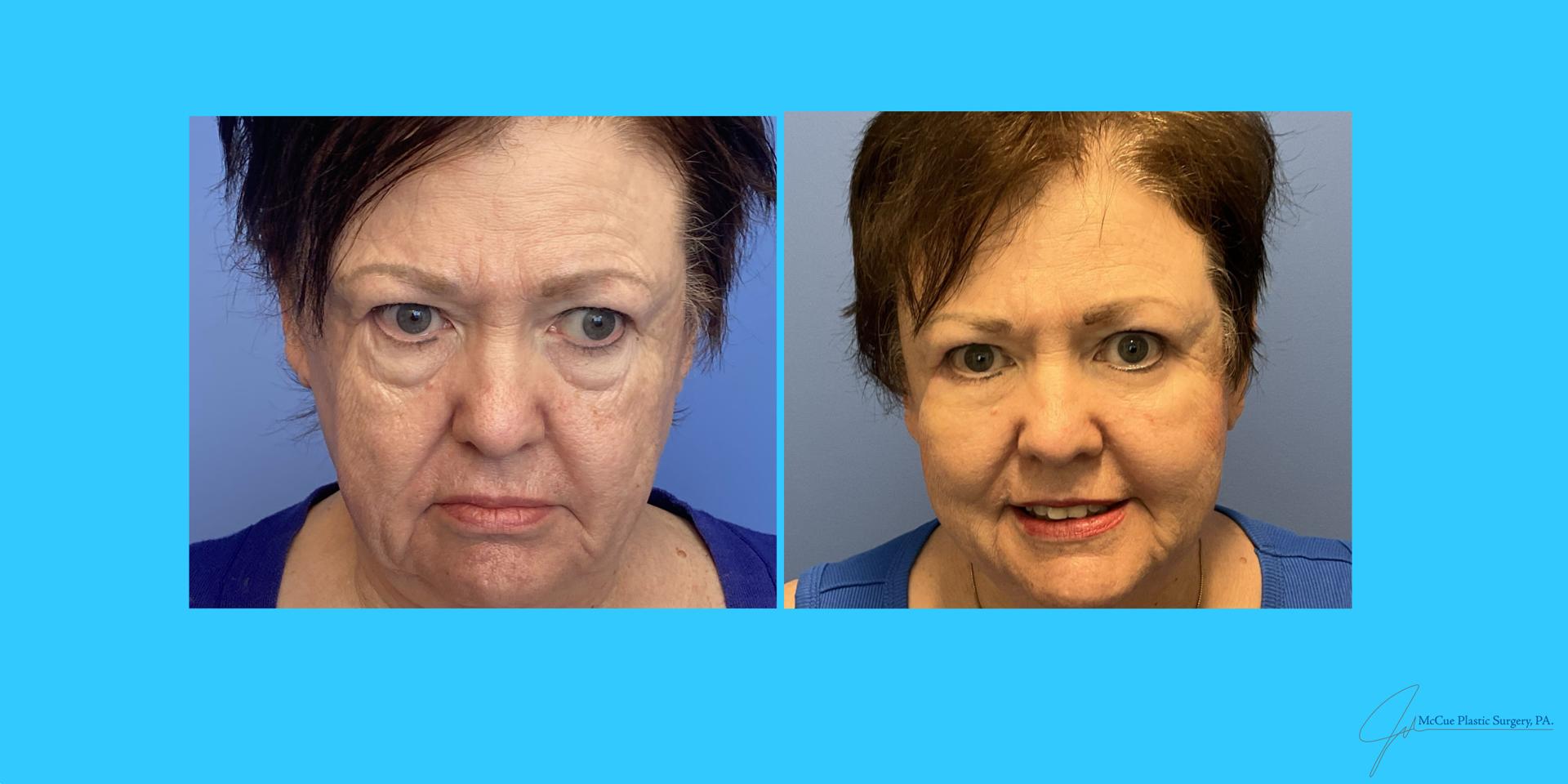 McCue Plastic Surgery blepharoplasty result — Plymouth, MN