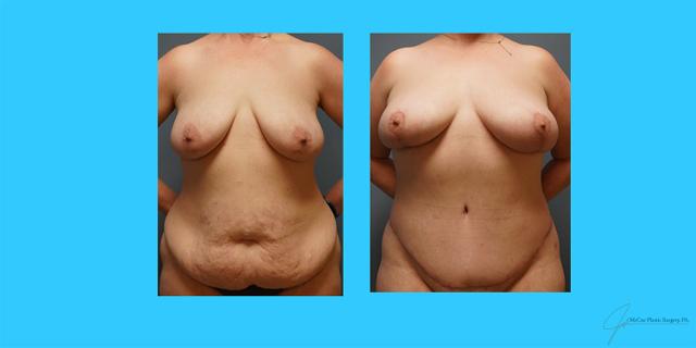 Mommy Makeover result at McCue Plastic Surgery in Plymouth, MN
