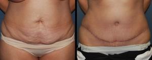 Mini Tummy Tuck result at McCue Plastic Surgery in Minneapolis, MN
