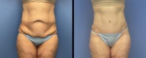Mini Tummy Tuck result at McCue Plastic Surgery in Minneapolis, MN