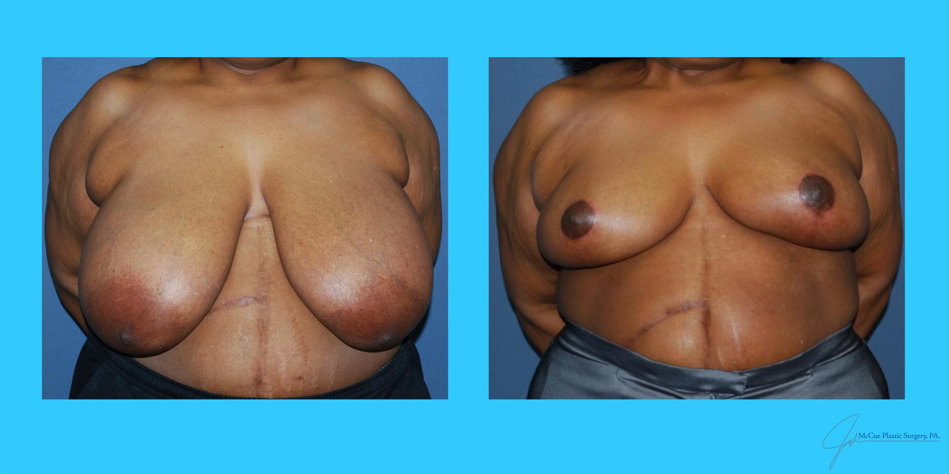 McCue Plastic Surgery breast reduction result — Plymouth, MN
