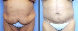 Mini Tummy Tuck result at McCue Plastic Surgery in Minneapolis, MN
