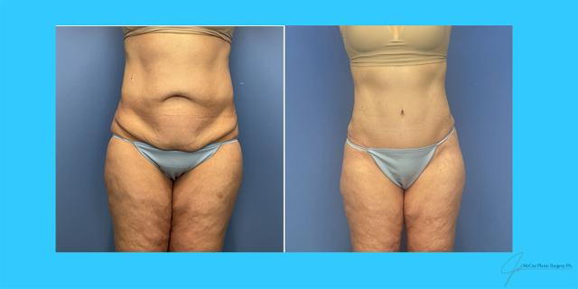 Mini Tummy Tuck result at McCue Plastic Surgery in Plymouth, MN