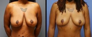 Breast Reduction result at McCue Plastic Surgery in Minneapolis, MN