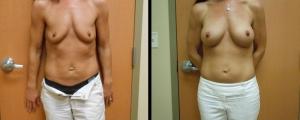 Breast Reduction result at McCue Plastic Surgery in Minneapolis, MN