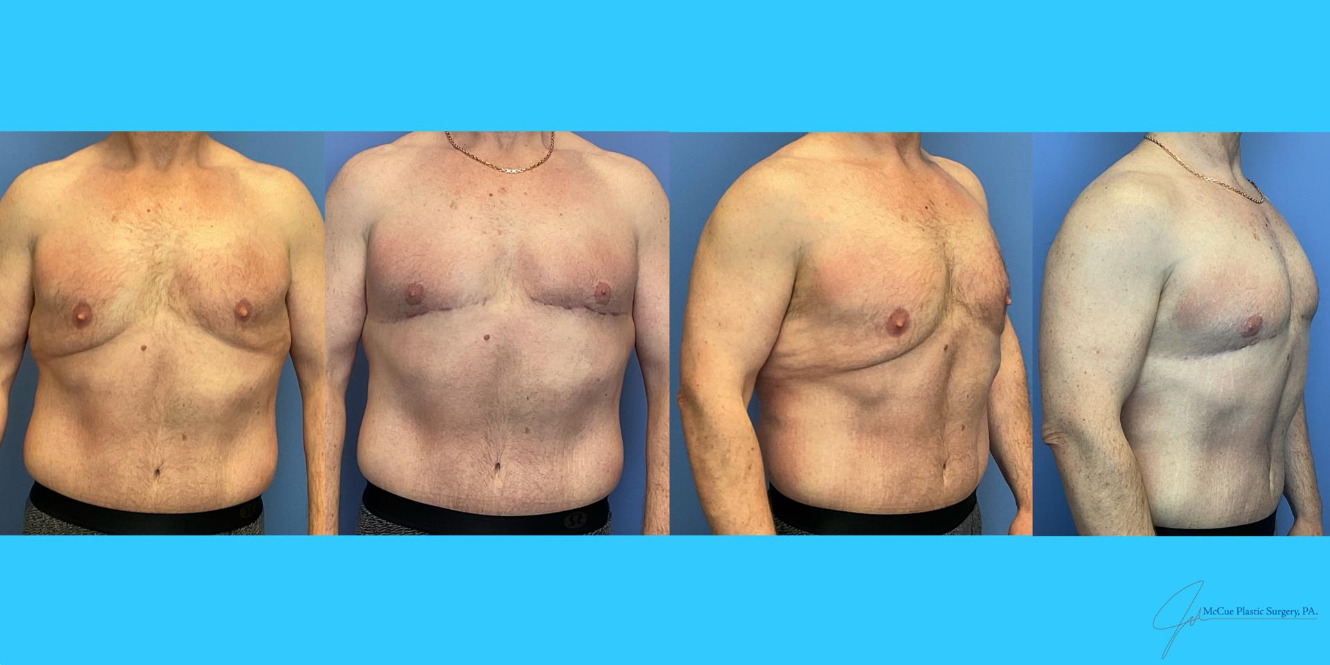 McCue Plastic Surgery body contouring result — Plymouth, MN