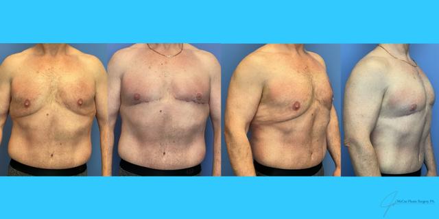 Thigh Lift result at McCue Plastic Surgery in Plymouth, MN