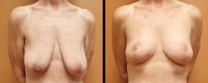 McCue Plastic Surgery breast lift result — Plymouth, MN