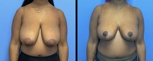 Breast Reduction result at McCue Plastic Surgery in Minneapolis, MN