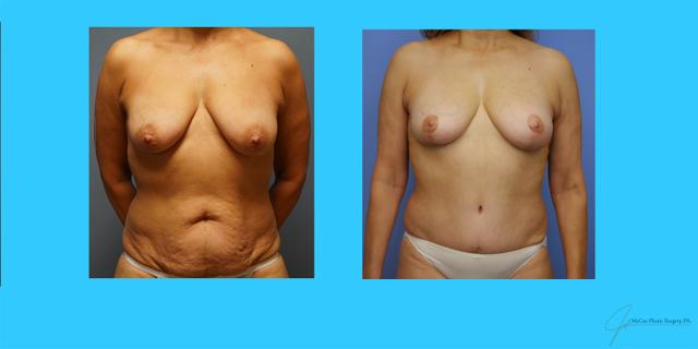 Mommy Makeover result at McCue Plastic Surgery in Plymouth, MN