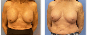 Breast Reduction result at McCue Plastic Surgery in Minneapolis, MN