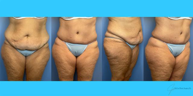 Mini Tummy Tuck result at McCue Plastic Surgery in Plymouth, MN