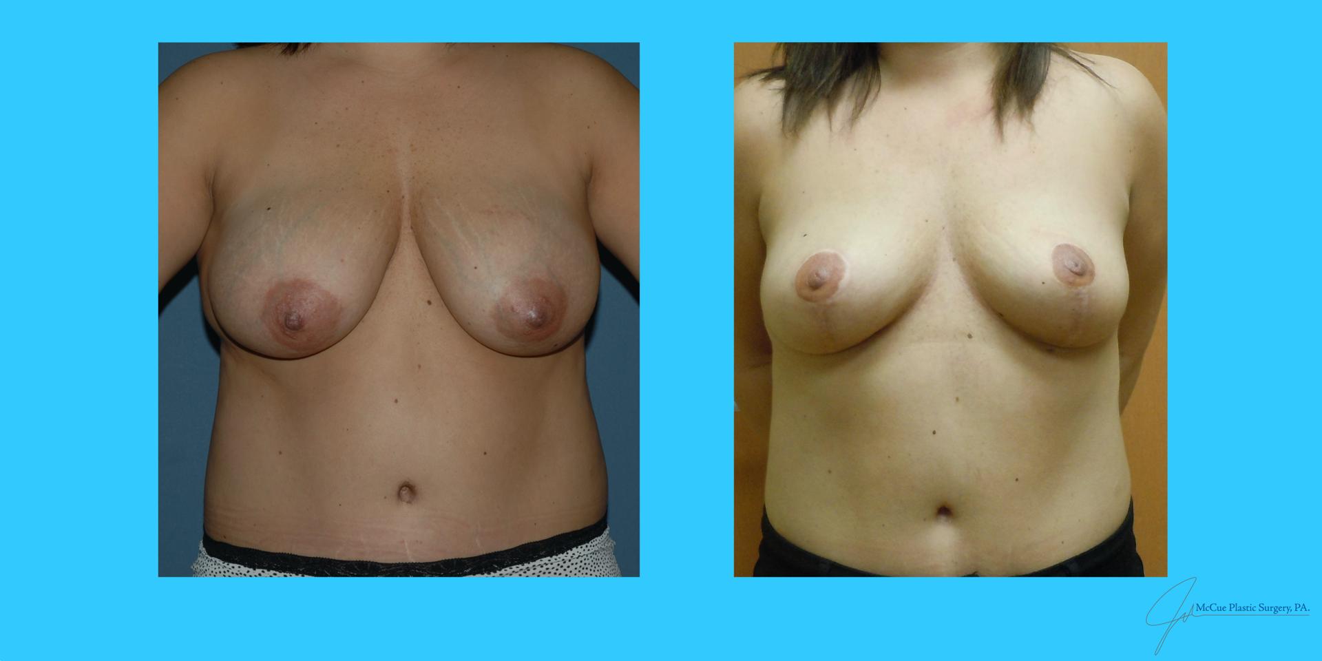 McCue Plastic Surgery breast reduction result — Plymouth, MN