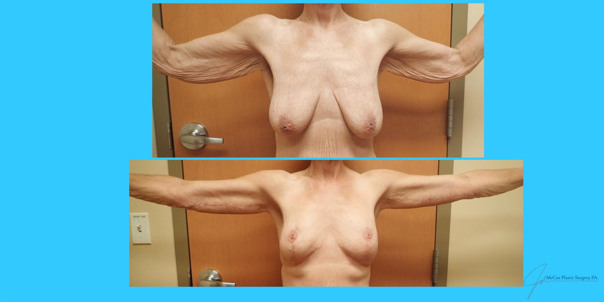 McCue Plastic Surgery breast lift result — Plymouth, MN