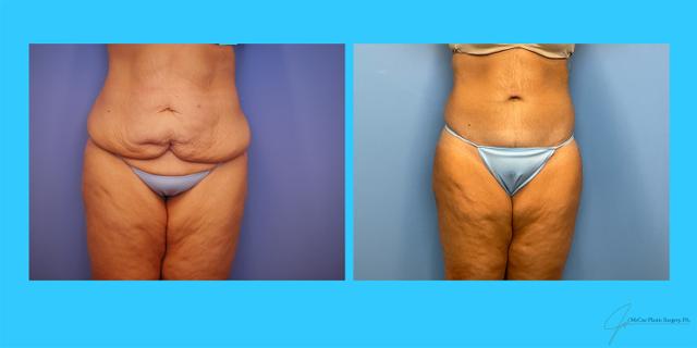 Mini Tummy Tuck result at McCue Plastic Surgery in Plymouth, MN