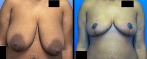 McCue Plastic Surgery breast reduction result — Minneapolis, MN