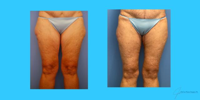 Thigh Lift result at McCue Plastic Surgery in Plymouth, MN