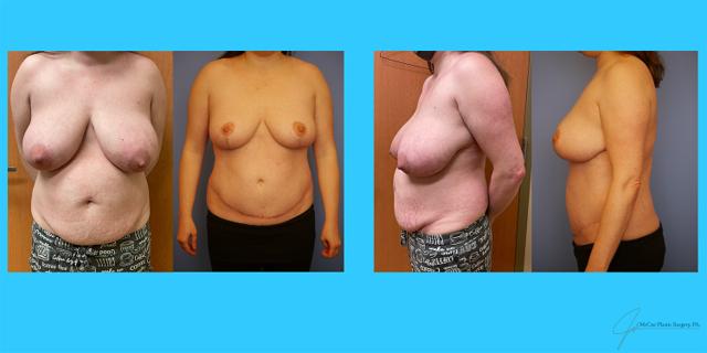 Mommy Makeover result at McCue Plastic Surgery in Plymouth, MN