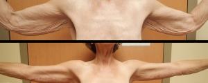 Arm Lift result at McCue Plastic Surgery in Minneapolis, MN