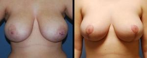 McCue Plastic Surgery breast reduction result — Minneapolis, MN