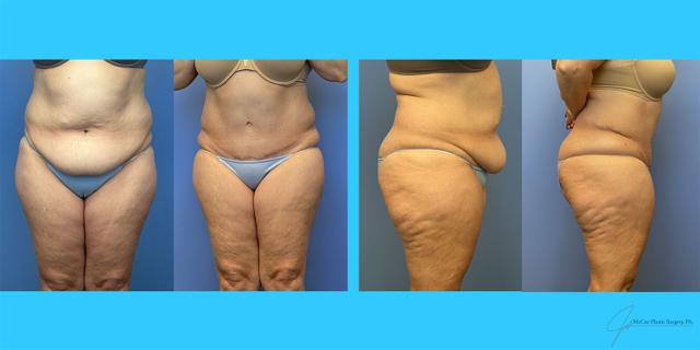 Mini Tummy Tuck result at McCue Plastic Surgery in Plymouth, MN