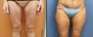 Arm Lift result at McCue Plastic Surgery in Minneapolis, MN