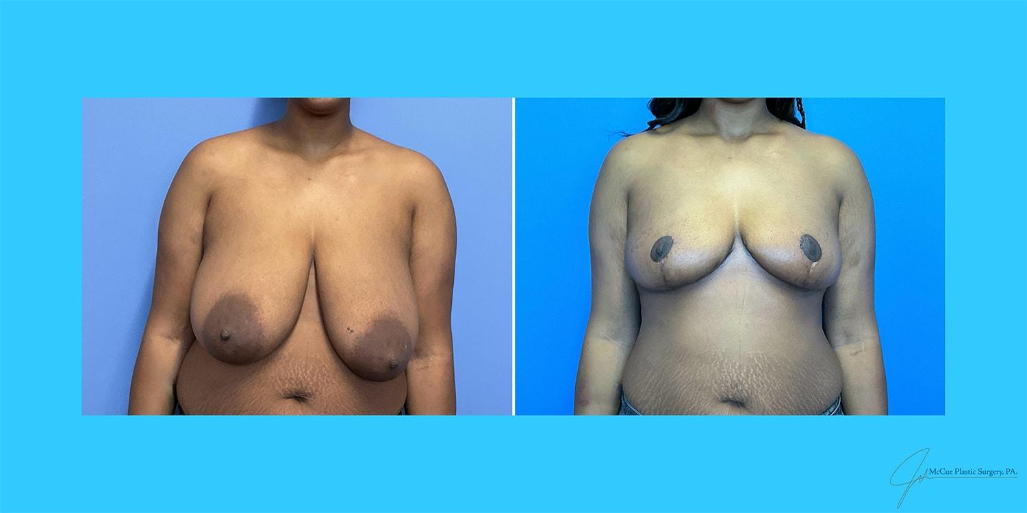 McCue Plastic Surgery breast reduction result — Plymouth, MN