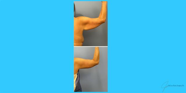 Arm Lift result at McCue Plastic Surgery in Plymouth, MN