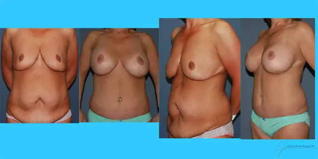 Mommy Makeover result at McCue Plastic Surgery in Plymouth, MN