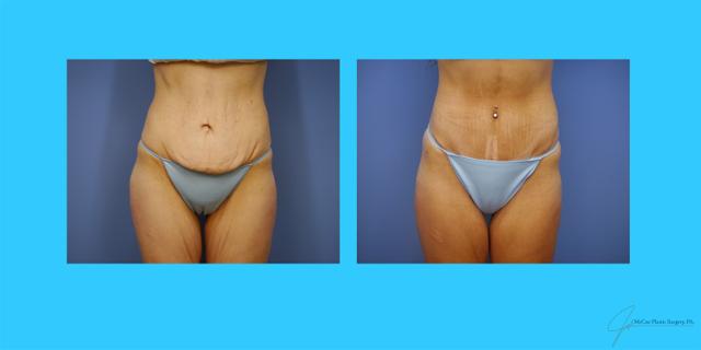 Mini Tummy Tuck result at McCue Plastic Surgery in Plymouth, MN