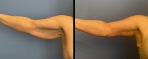 Arm Lift result at McCue Plastic Surgery in Minneapolis, MN